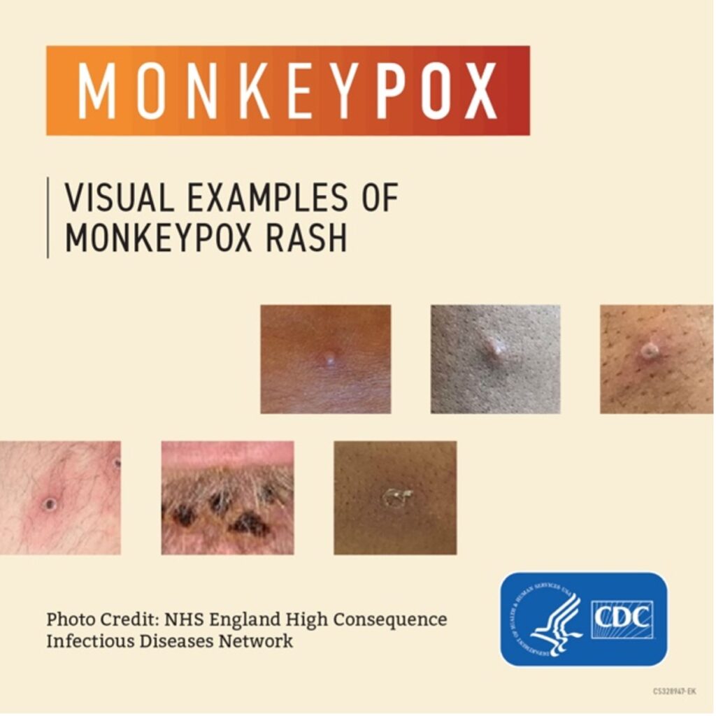 Visual examples of Monkeypox rash, showing poxes on light skin. Image created by the CDC, and photo credit to NHS England High Consequence Infectious Diseases Network