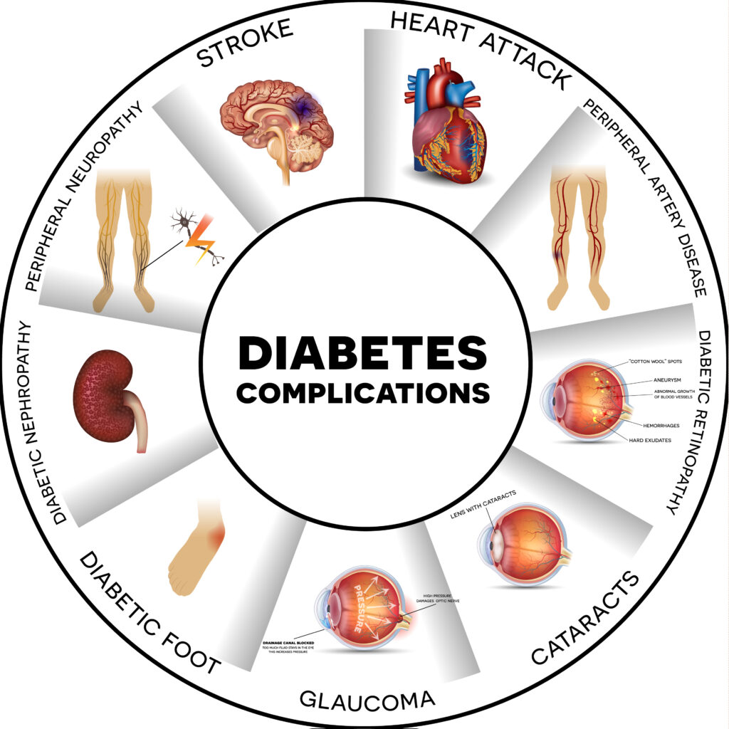 Diabetes complications affected organs. Diabetes affects nerves with peripheral neuropathy; kidneys with diabetic nephropathy; eyes with glaucoma, cataracts or diabetic retinopathy;, vessels with peripheral artery disease; heart with heart attack; brain with stroke and skin. Round info graphic.